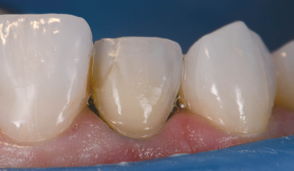 Figs. 2a & b: Veneer preparation of teeth #12 and 22.