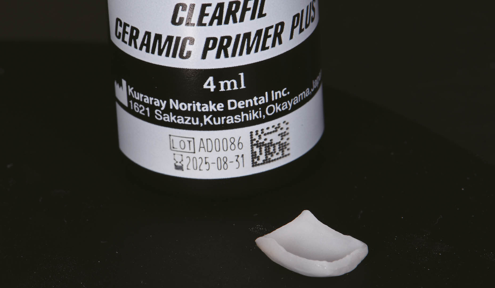 Fig. 3: CLEARFIL CERAMIC PRIMER PLUS, which was applied to the intaglio surfaces of the veneers.